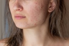 cropped-shot-young-womans-face-with-problem-acne-pimples-red-scars-cheeks-chin.jpg